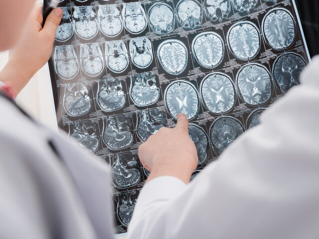 Шведские ученые выявили новую агрессивную форму болезни Альцгеймера